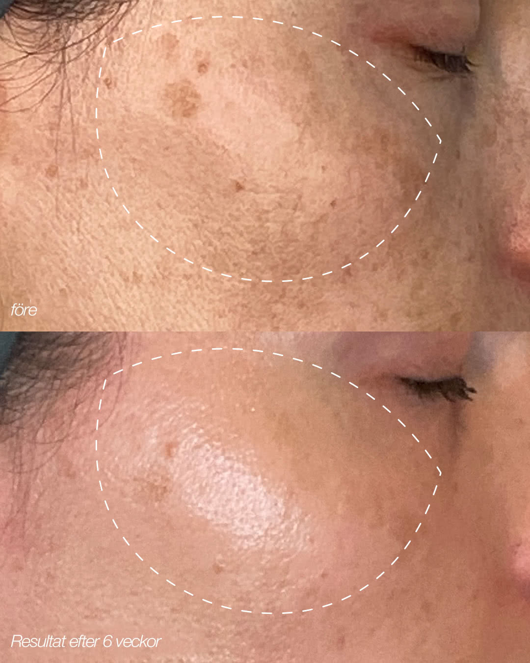 melanotan fre efter bilder Dangerous' tanning products promoted by influencers En Annan Del Av Frorten